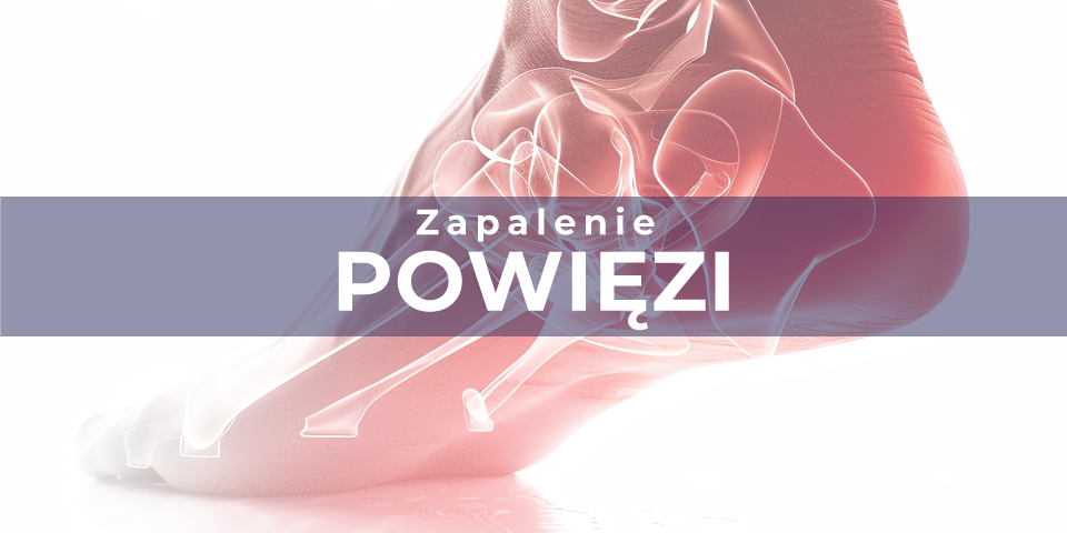 ZAPALENIE POWIĘZI PODESZWY